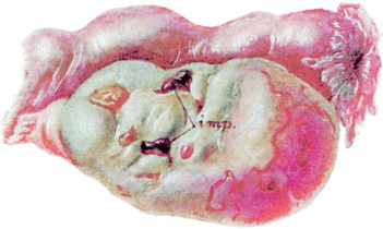 Drawings of endometriosis specimens from John Sampson's works of the 1920s-DR